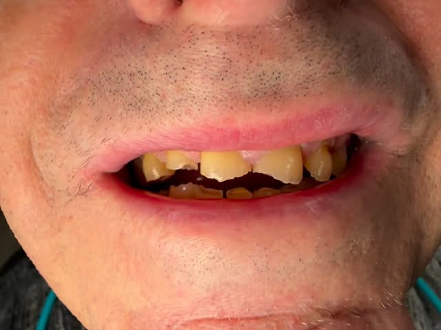 Stillbild ur video från inlägget: Idag har vi hjälpt en patient med omfattande slitage i både över- och underkäken.