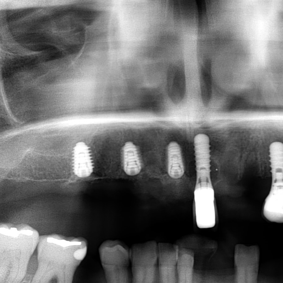 Bild från inlägget: Idag satte vi 3 implantat i överkäkens högra sida