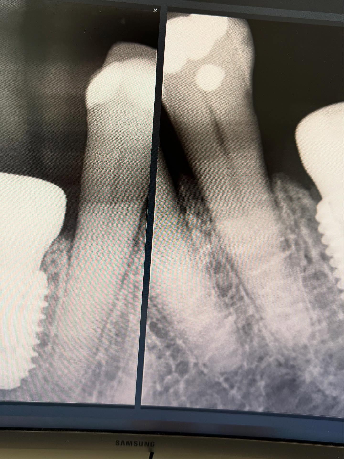 Bild från inlägget: Idag har vi satt två implantat i underkäken på en modig patient – och allt gick superbra! – bild 2