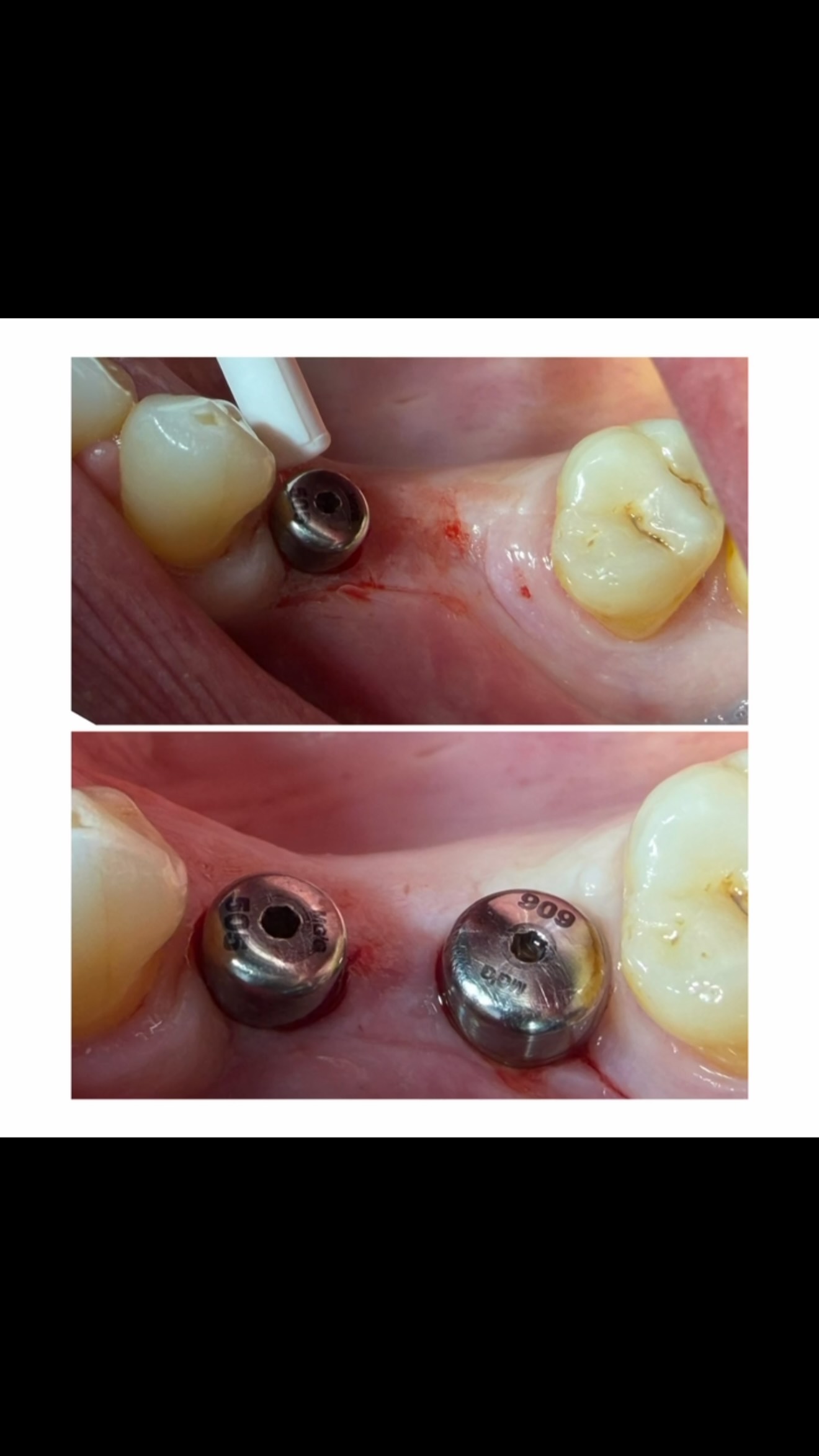 Stillbild ur video från inlägget: Distansoperation efter implantatbehandling