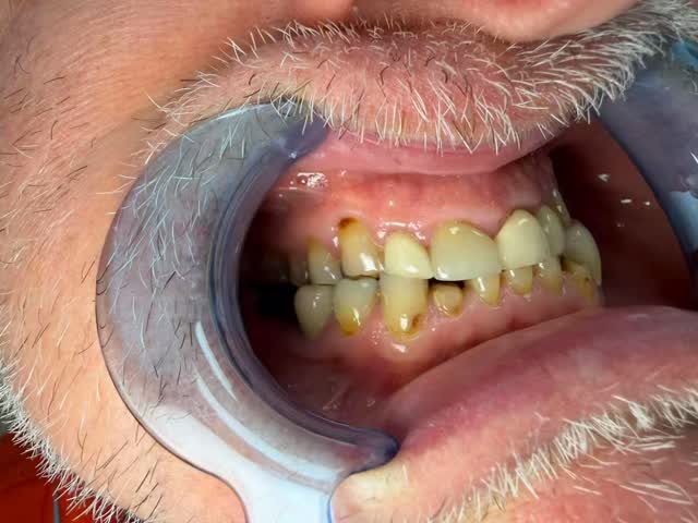 Stillbild ur video från inlägget: Smile makeover på gång!