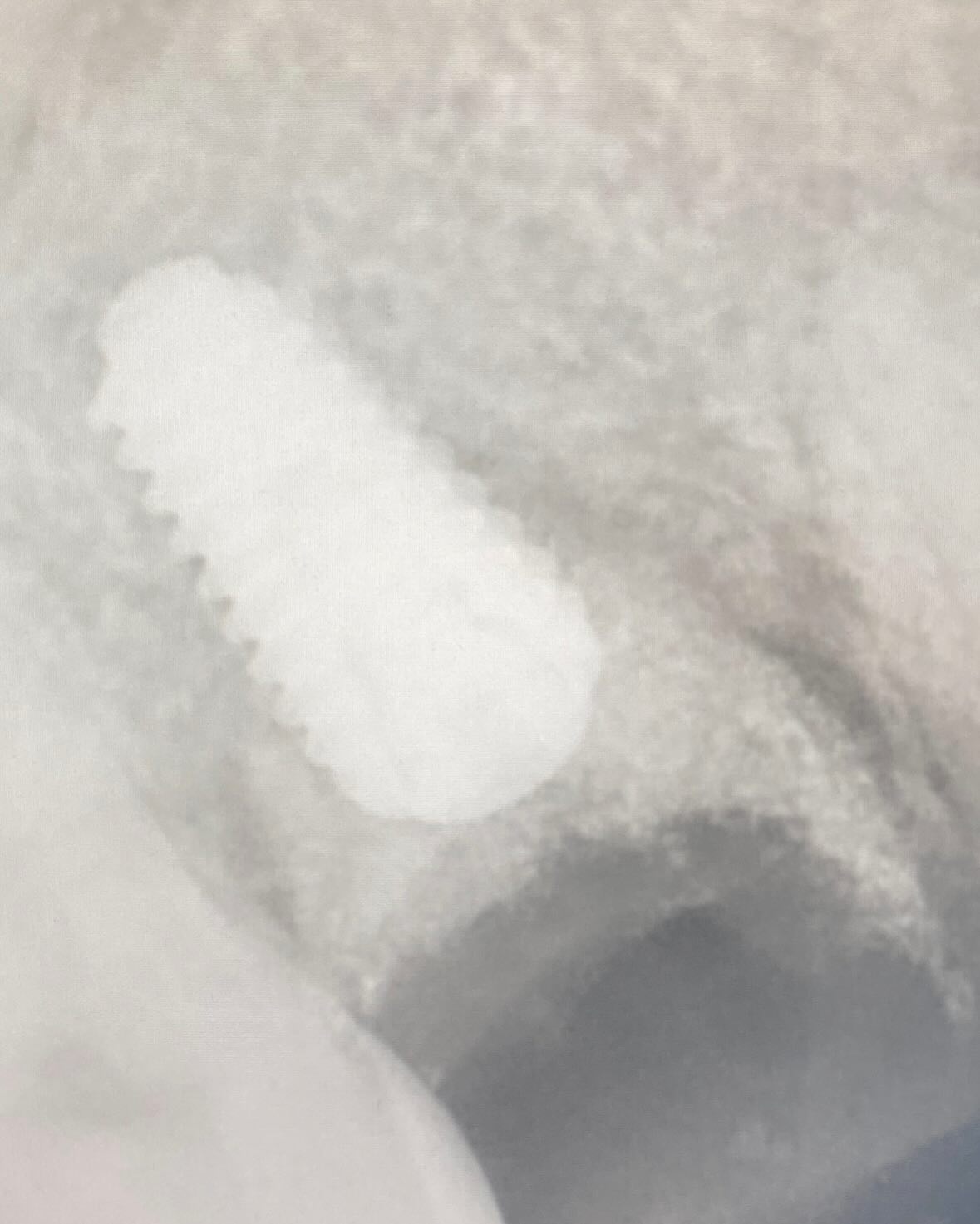 Bild från inlägget: Idag satte vi ett implantat av en lite mer avancerad variant! – bild 3