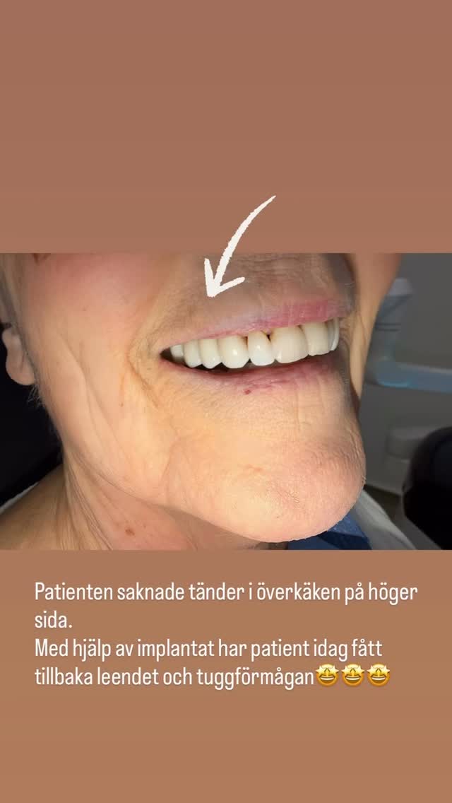 Stillbild ur video från inlägget: Patientens önskan var att kunna tugga och äta som vanligt.