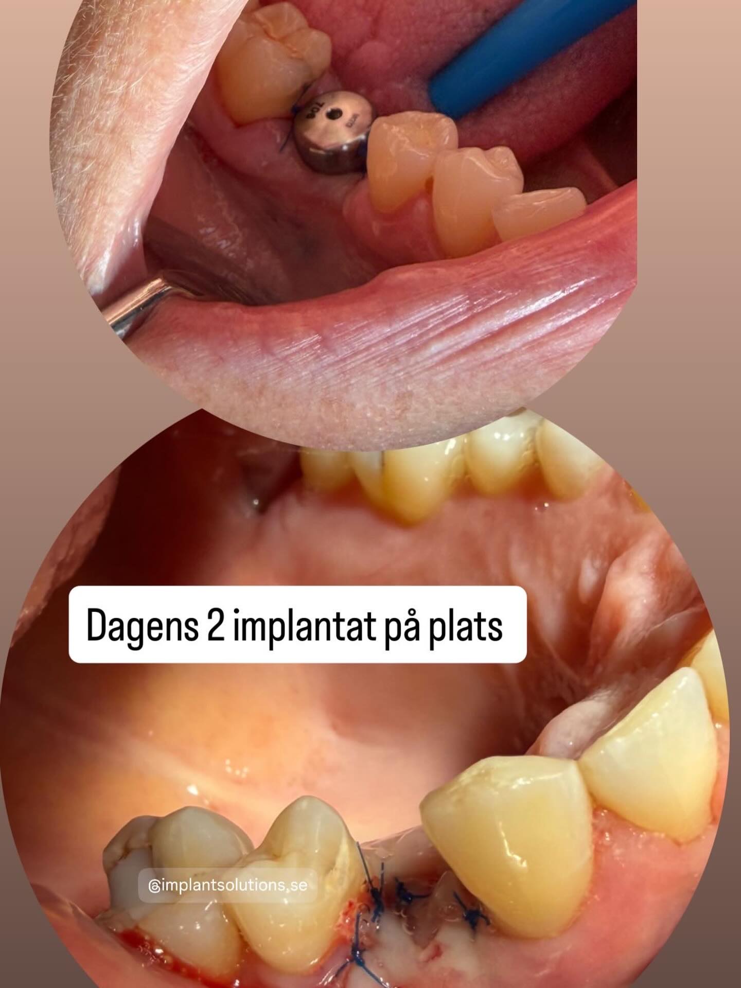 Bild från inlägget: Dagens 2 implantat på sin plats