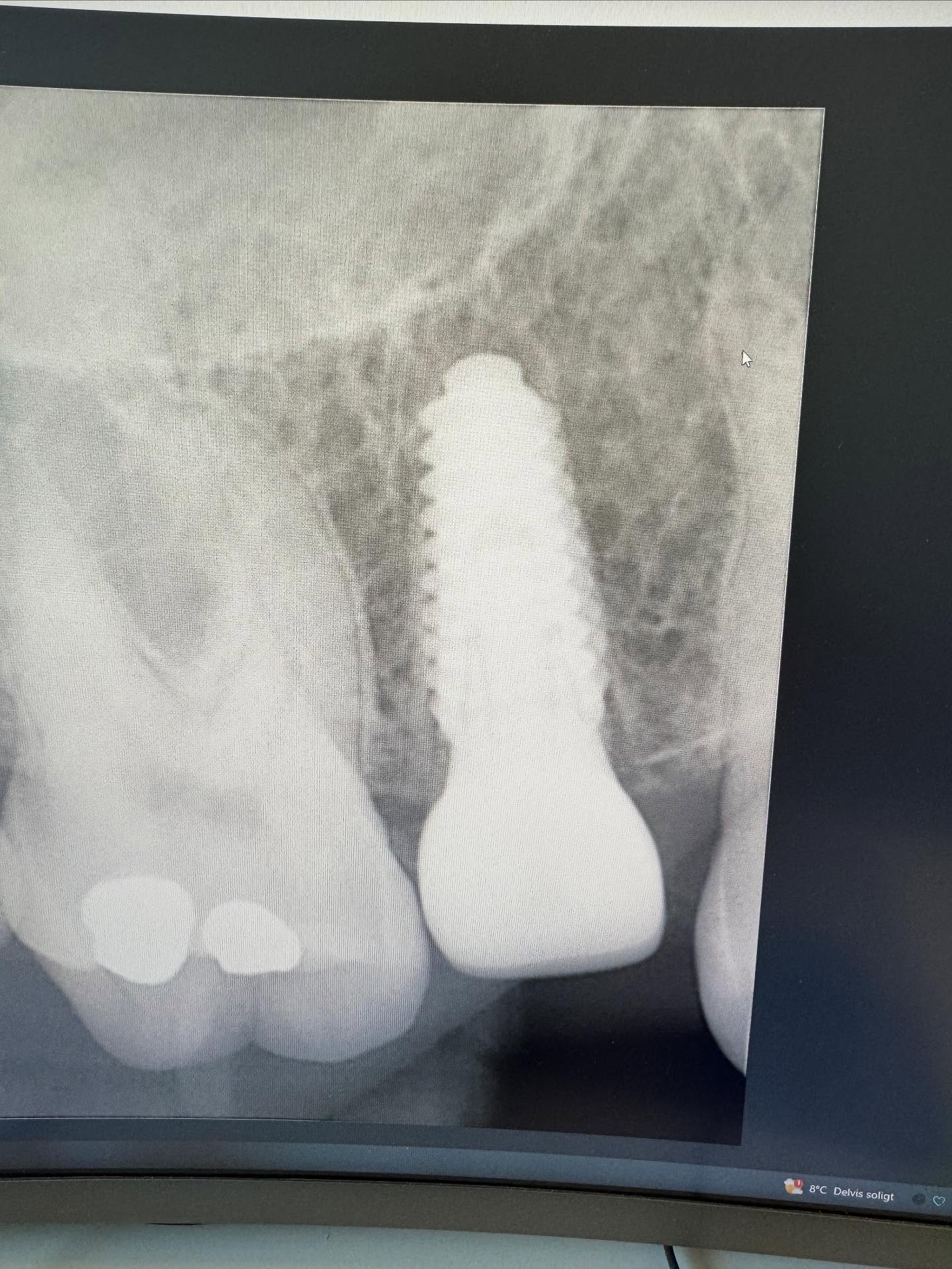 Bild från inlägget: Dagens implantat operation – bild 2