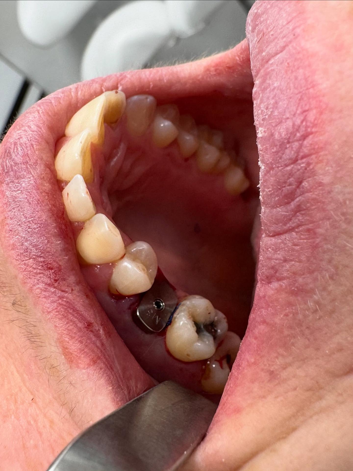 Bild från inlägget: Dagens implantat operation – bild 3