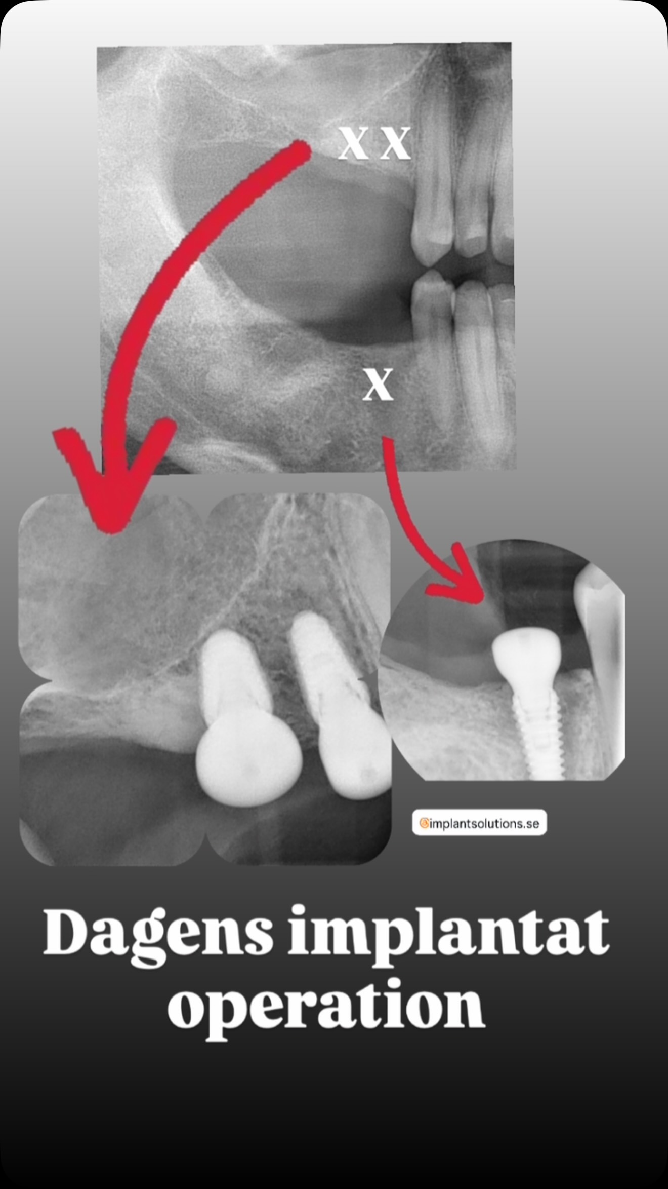 Stillbild ur video från inlägget: Tre implantat i en smäll!