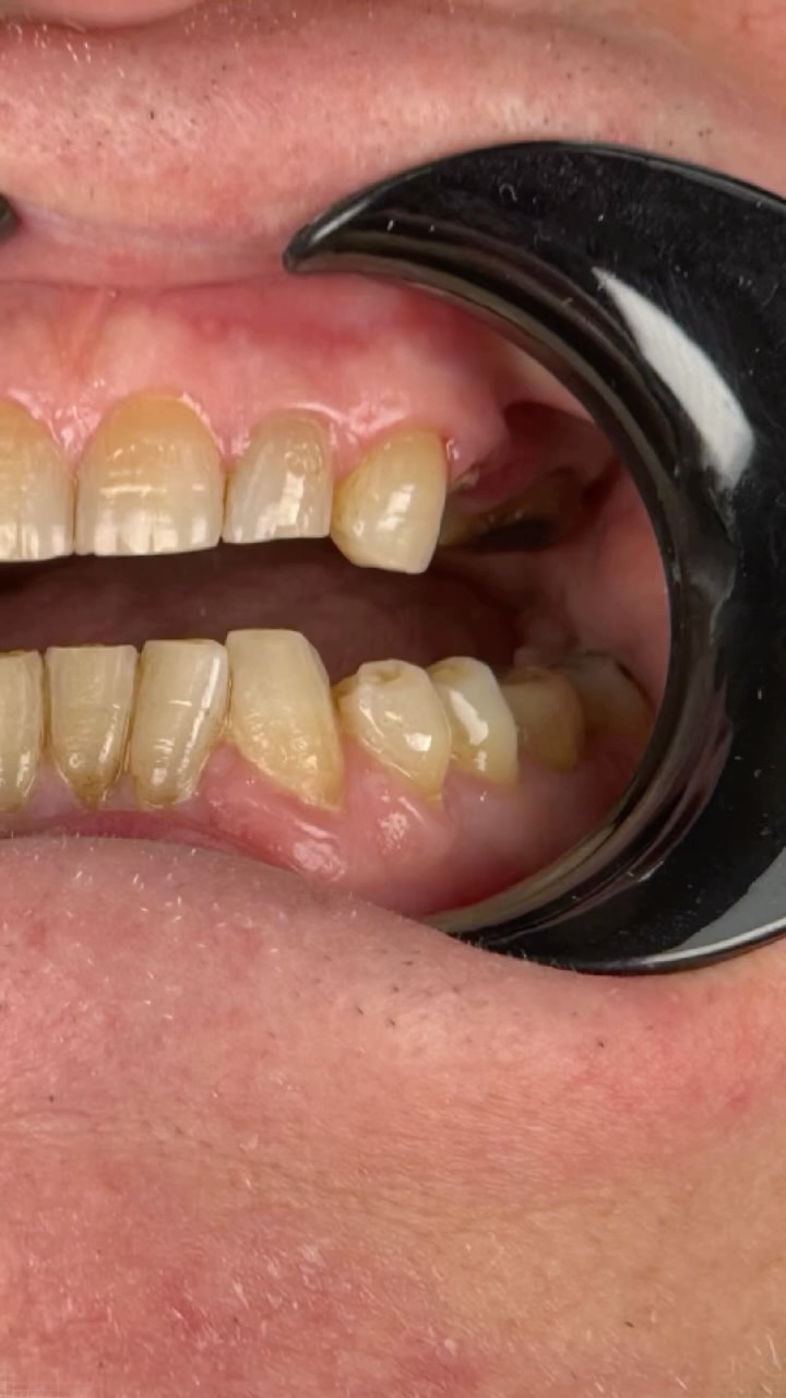 Stillbild ur video från inlägget: Fantastiskt resultat med en tandstödsbro!