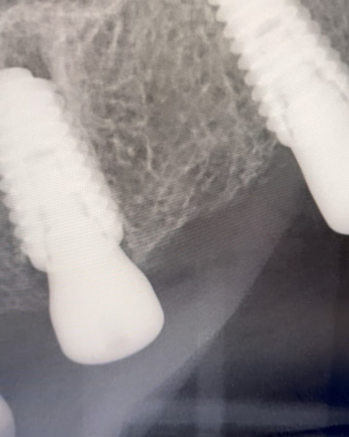 Bild från inlägget: Idag genomförde vi en direktinstallation av 4 implantat i överkäken – bild 3