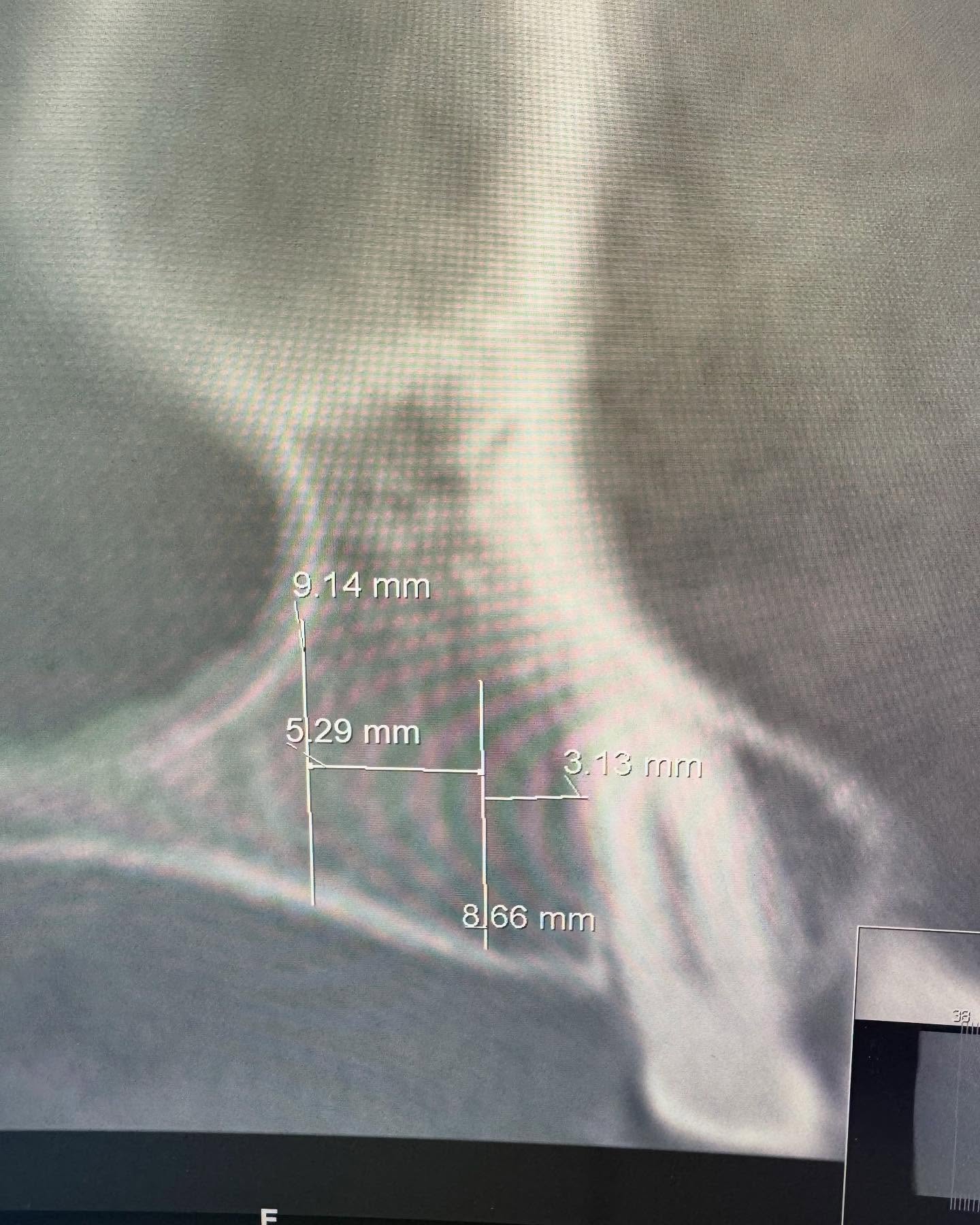 Bild från inlägget: Två implantat satta i överkäken för att ersätta tandlöshet – bild 1