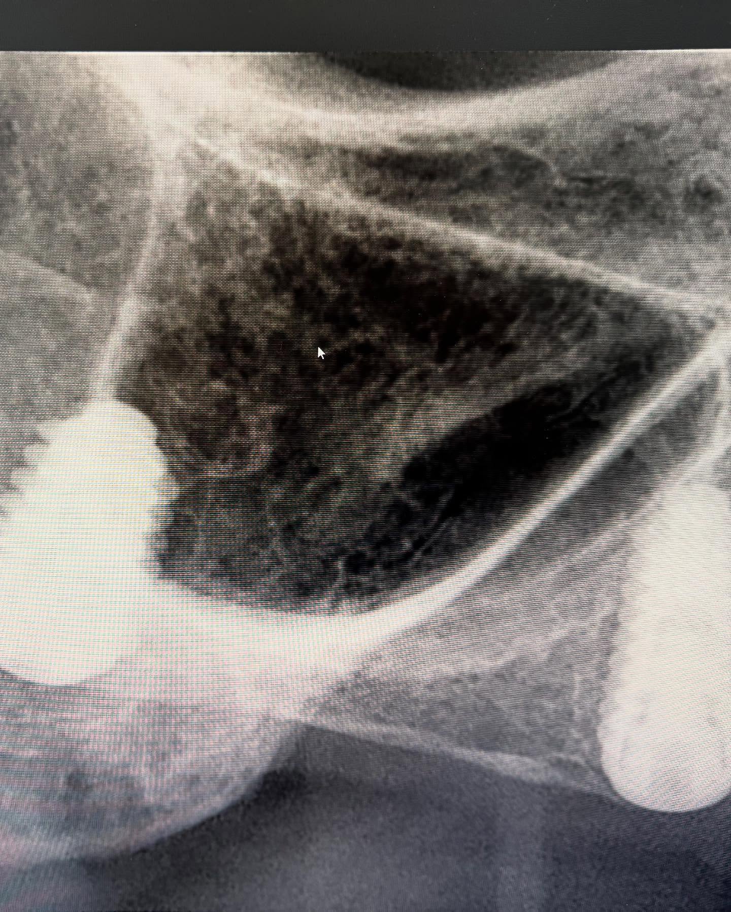 Bild från inlägget: Två implantat satta i överkäken för att ersätta tandlöshet – bild 2