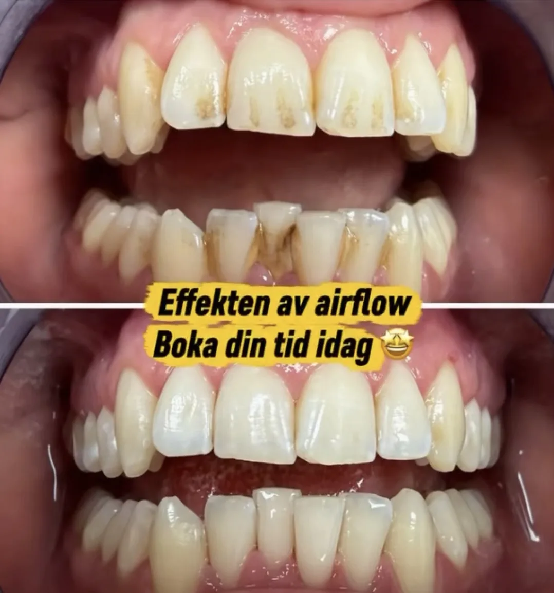 Före- och efterbild av tänderna med texten Effekten av airflow