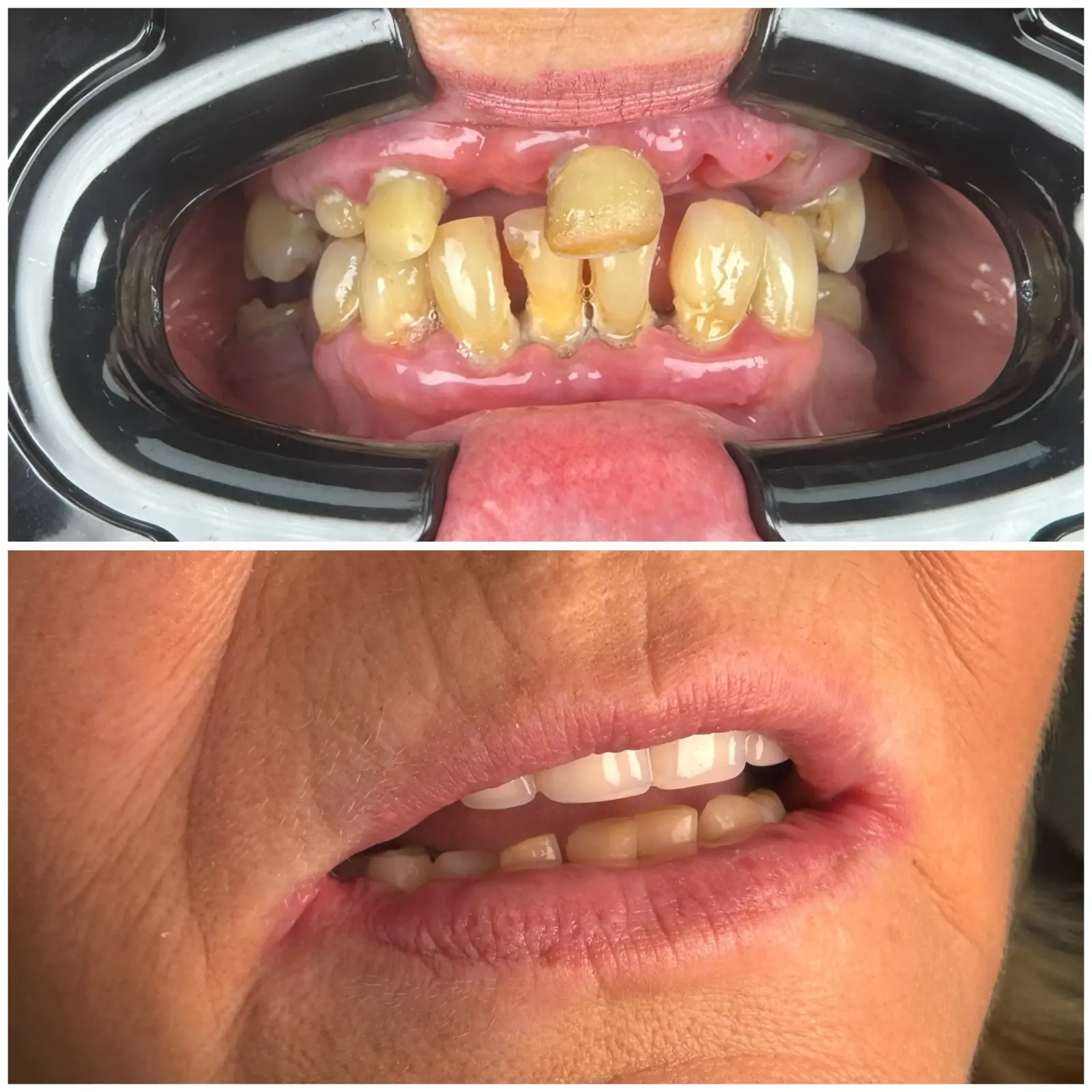 Före- och efterbild av ett leende från ett patientinlägg på klinikens Instagram
