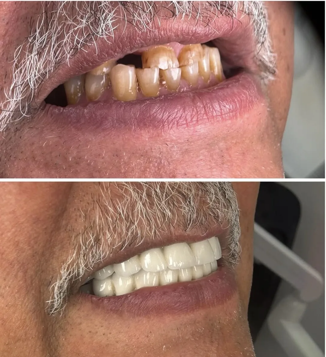 Före- och efterbild av framtänderna från en behandling på kliniken