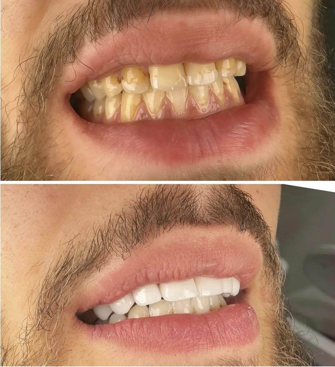 Före- och efterbild av tänderna i överkäken från en behandling på kliniken