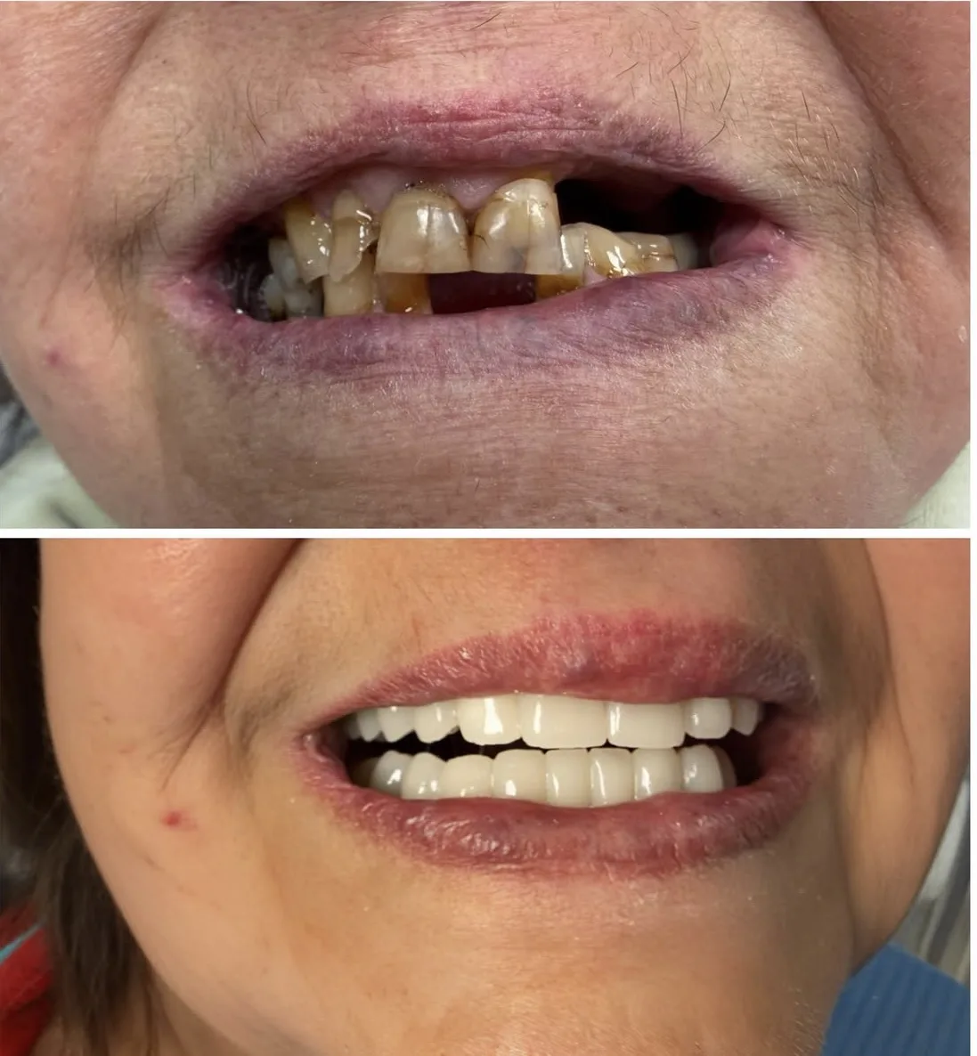 Före- och efterbild av tänderna från en behandling på kliniken