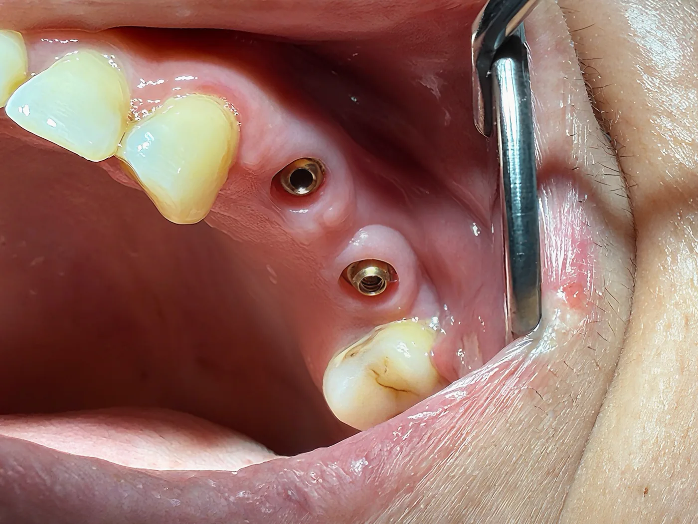 Två implantat med distanser i munnen, precis innan en implantatbro sätts fast