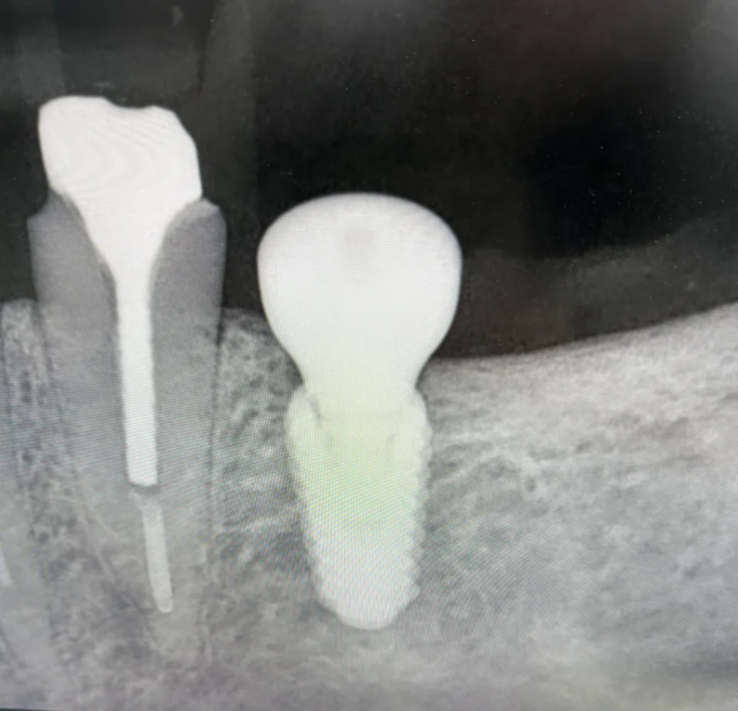 Röntgenbild av en implantatkrona bredvid en rotfylld tand